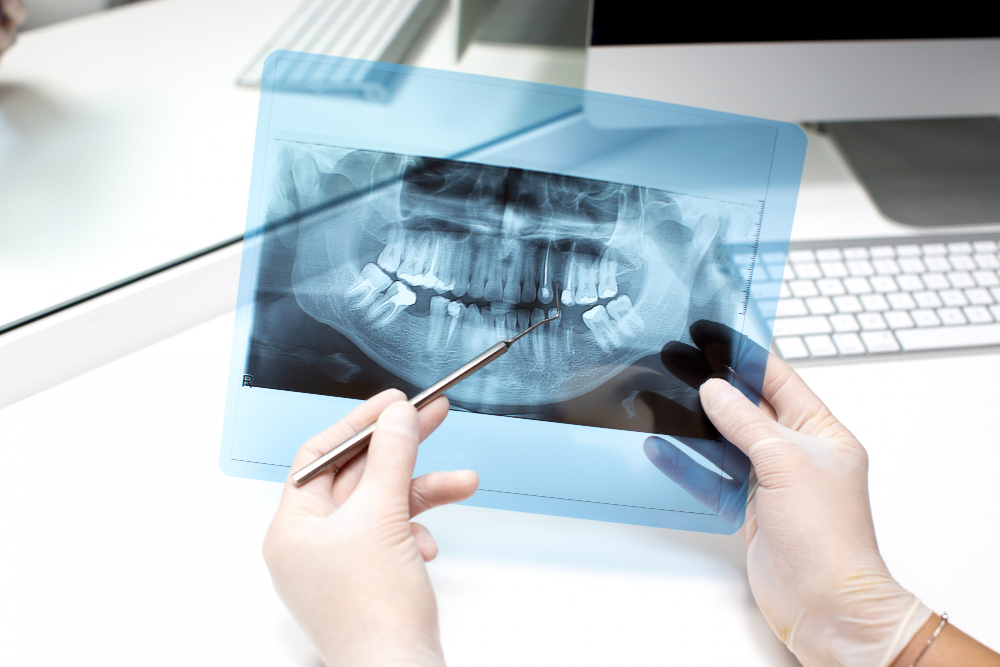 Dental_X ray